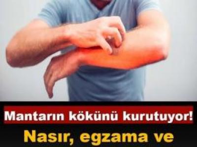 Nasır, egzama ve mantara 5 dakikada çözüm.