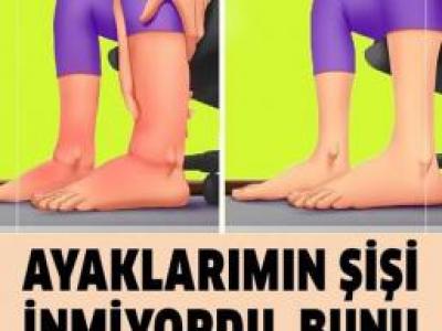 Ayaklarımın Şişi İnmiyordu, Bunu Tavsiye Ettiler