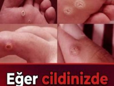 İşte Tedavisi..