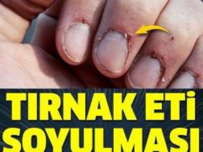 tırnak eti soyulması