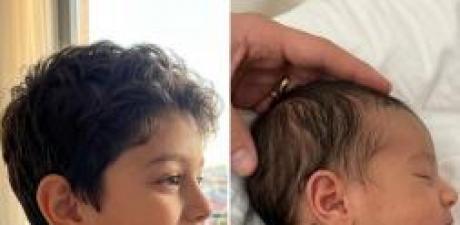 Arkadaşımın oğlu aynı nadir doğum lekesiyle
