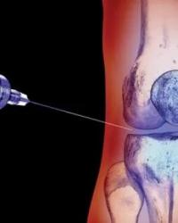 Eksozom Tedavisiyle Diz Kireçlenmesi Tedavisinde Yeni Dönem