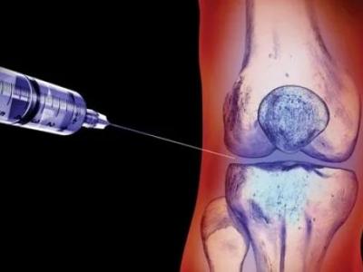 Eksozom Tedavisiyle Diz Kireçlenmesi Tedavisinde Yeni Dönem