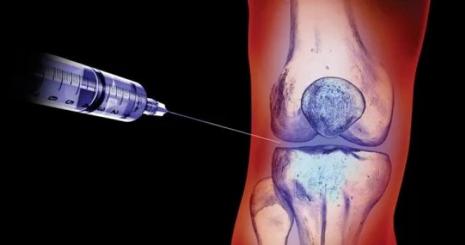 Eksozom Tedavisiyle Diz Kireçlenmesi Tedavisinde Yeni Dönem
