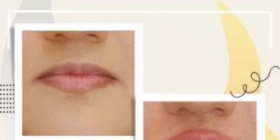 Dolgu, Botox ve Fraksiyonel Lazer: Ameliyatsız Estetikte Doğru Bilinen Yanlışlar