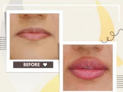 Dolgu, Botox ve Fraksiyonel Lazer: Ameliyatsız Estetikte Doğru Bilinen Yanlışlar