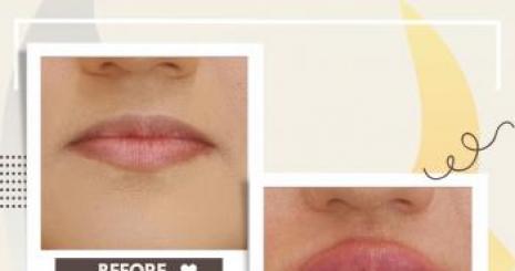 Dolgu, Botox ve Fraksiyonel Lazer: Ameliyatsız Estetikte Doğru Bilinen Yanlışlar