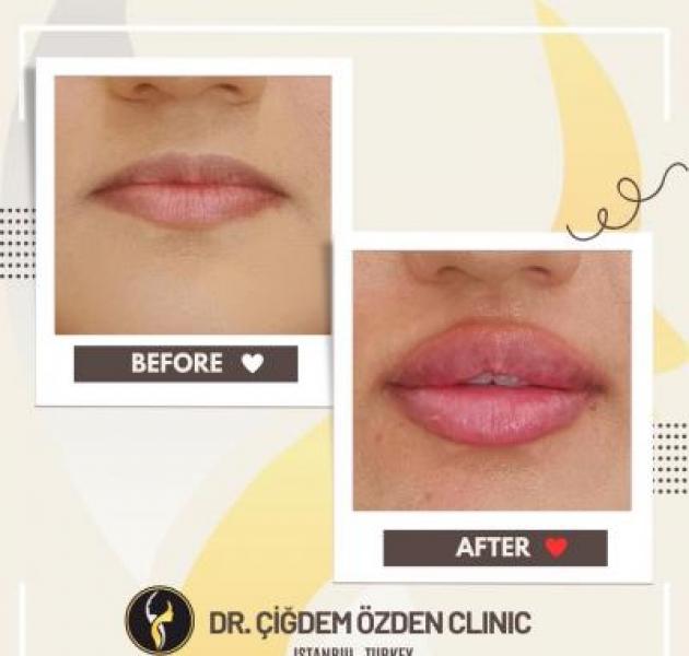 Dolgu, Botox ve Fraksiyonel Lazer: Ameliyatsız Estetikte Doğru Bilinen Yanlışlar